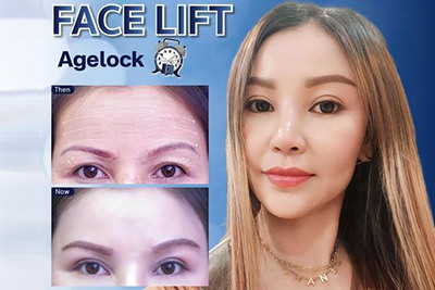 ดึงหน้า_Mini_Facelift